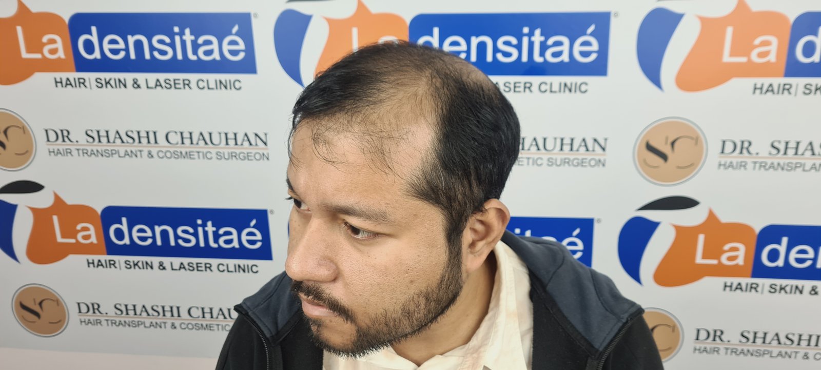 Dr. Bishal Before Hair Transplant